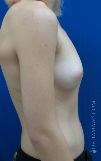 Breast Augmentation Before and After | Princeton Plastic Surgeons