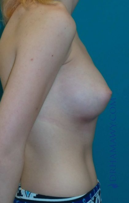 Breast Augmentation Before and After | Princeton Plastic Surgeons