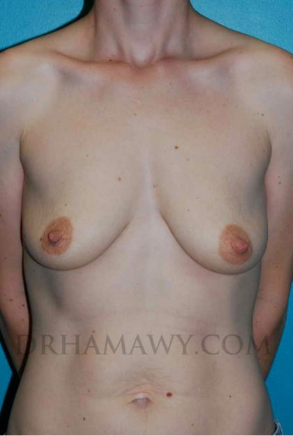 Breast Augmentation Before and After | Princeton Plastic Surgeons