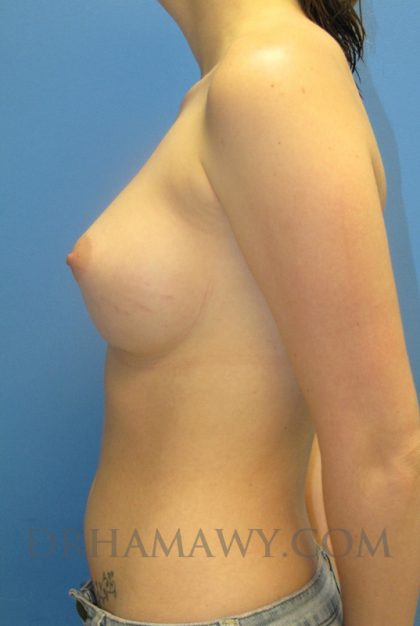 Breast Augmentation Before and After | Princeton Plastic Surgeons