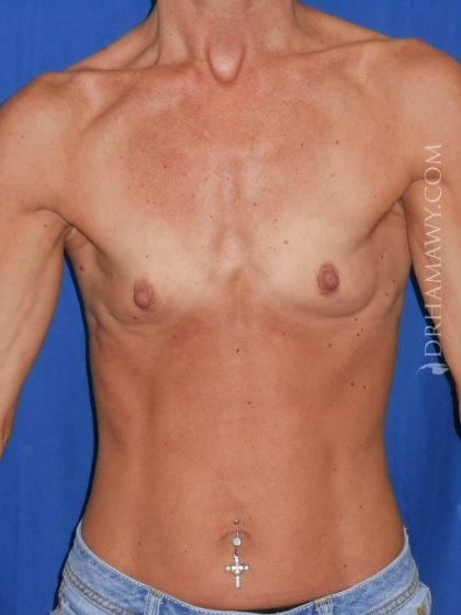 Breast Augmentation Before and After | Princeton Plastic Surgeons