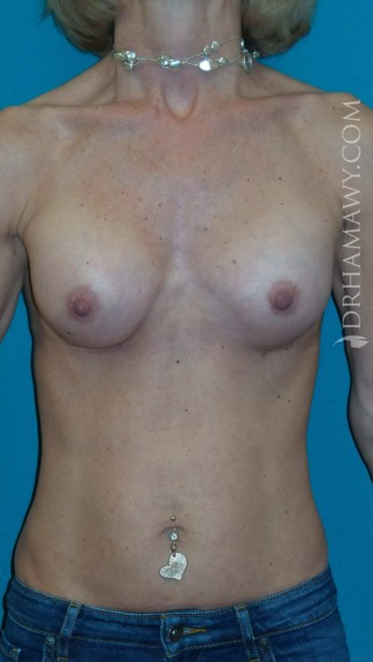 Breast Augmentation Before and After | Princeton Plastic Surgeons