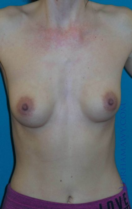 Breast Augmentation Before and After | Princeton Plastic Surgeons