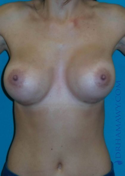 Breast Augmentation Before and After | Princeton Plastic Surgeons