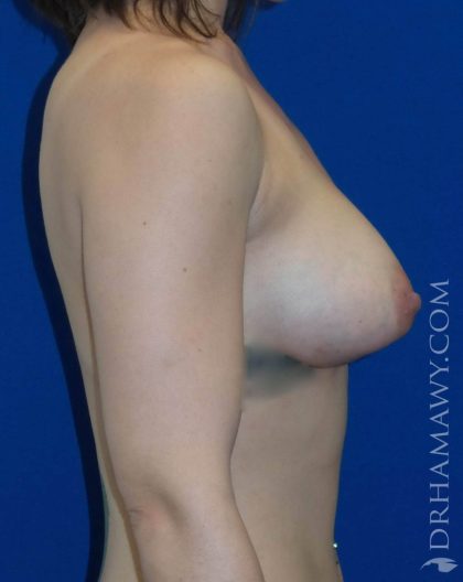 Breast Augmentation Before and After | Princeton Plastic Surgeons