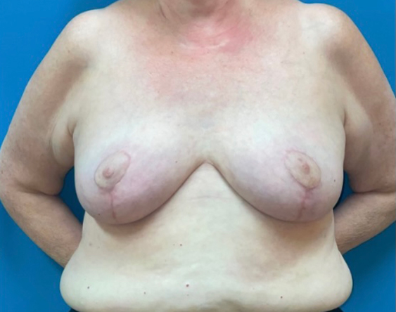 Breast Augmentation Before and After | Princeton Plastic Surgeons