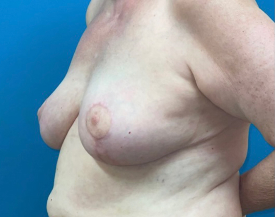 Breast Augmentation Before and After | Princeton Plastic Surgeons