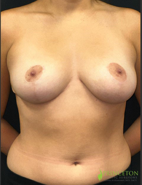 Breast Lift Before and After | Princeton Plastic Surgeons