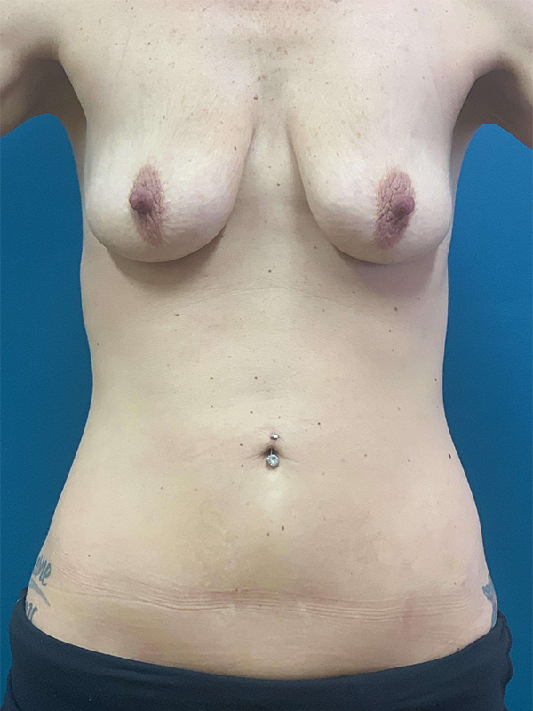 Breast Lift Before and After | Princeton Plastic Surgeons