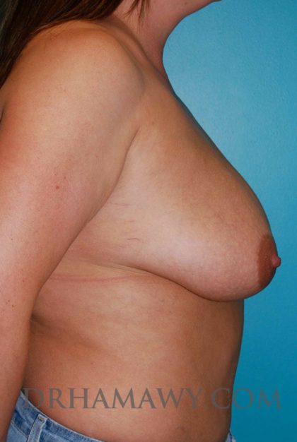 Breast Lift Before and After | Princeton Plastic Surgeons