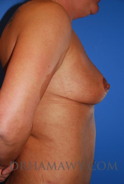 Breast Lift Before and After | Princeton Plastic Surgeons