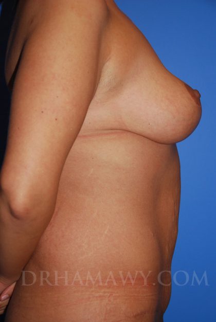 Breast Lift Before and After | Princeton Plastic Surgeons