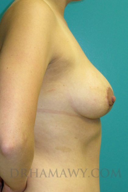 Breast Lift Before and After | Princeton Plastic Surgeons