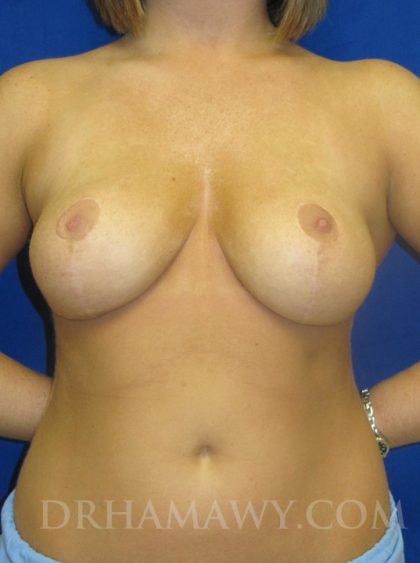 Breast Reduction Before and After | Princeton Plastic Surgeons