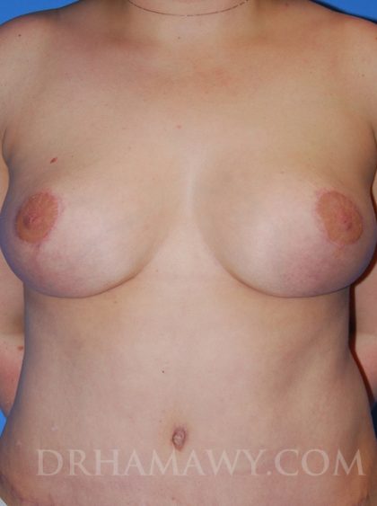 Breast Reduction Before and After | Princeton Plastic Surgeons