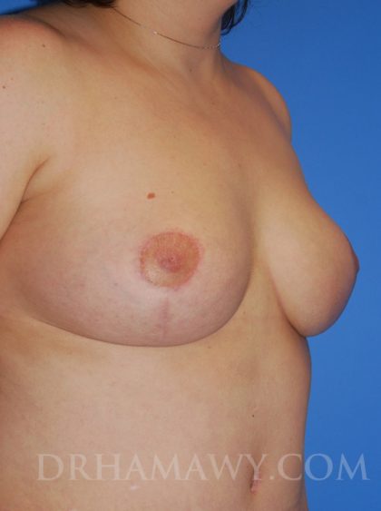 Breast Reduction Before and After | Princeton Plastic Surgeons