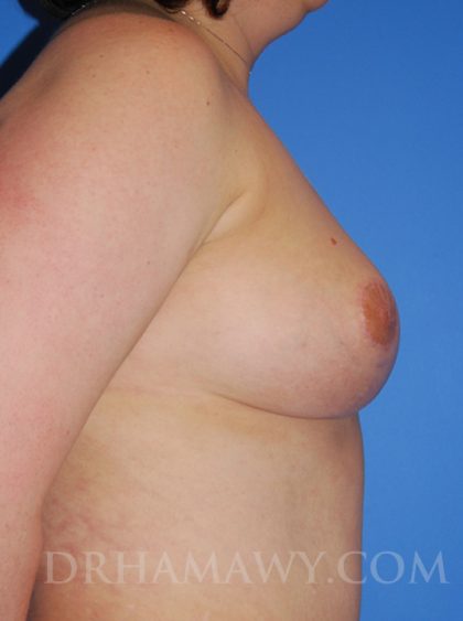 Breast Reduction Before and After | Princeton Plastic Surgeons