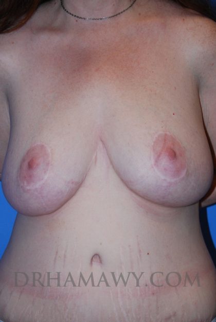 Breast Reduction Before and After | Princeton Plastic Surgeons