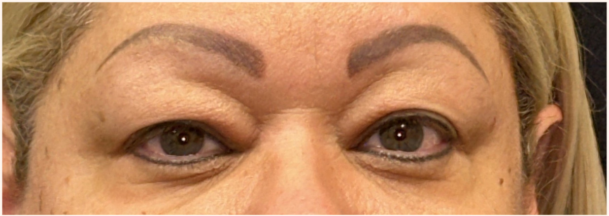 Eyelid Surgery Before and After | Princeton Plastic Surgeons