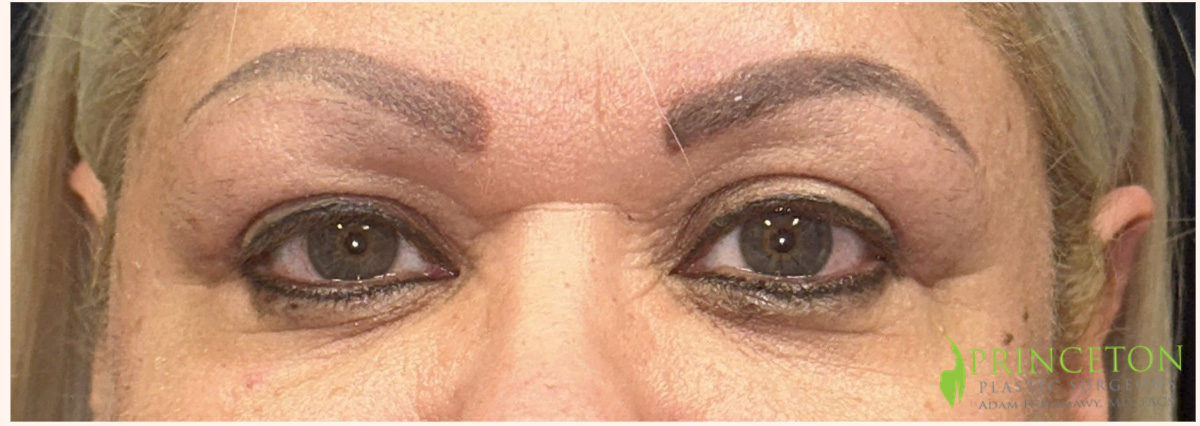 Eyelid Surgery Before and After | Princeton Plastic Surgeons