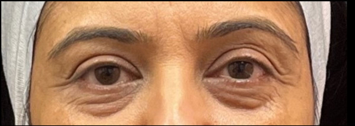 Eyelid Surgery Before and After | Princeton Plastic Surgeons