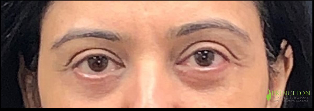 Eyelid Surgery Before and After | Princeton Plastic Surgeons