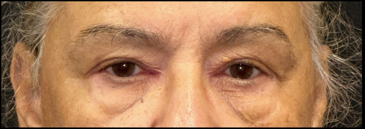 Eyelid Surgery Before and After | Princeton Plastic Surgeons