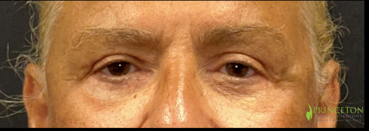 Eyelid Surgery Before and After | Princeton Plastic Surgeons