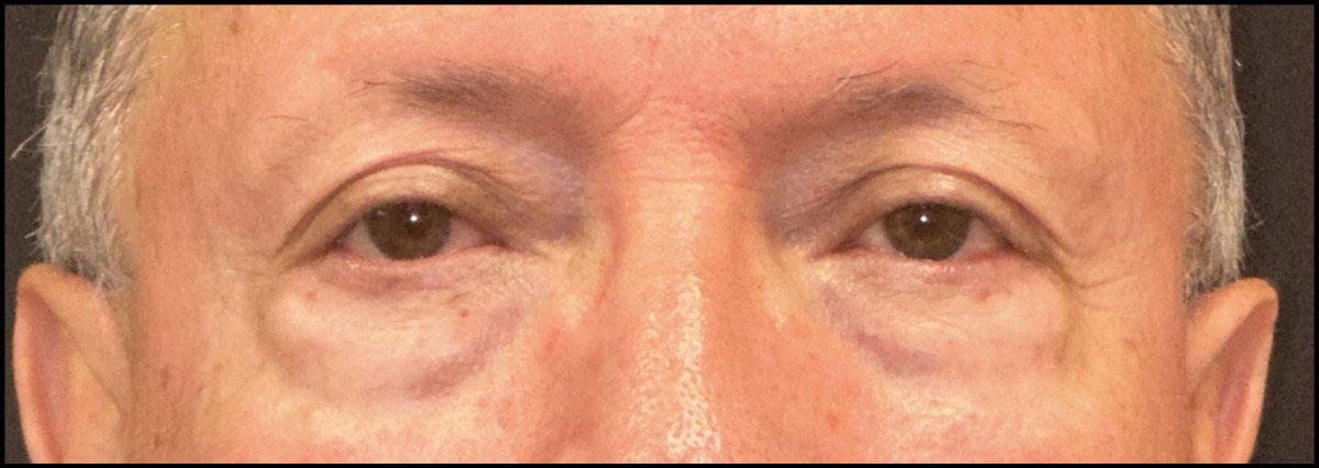 Eyelid Surgery Before and After | Princeton Plastic Surgeons