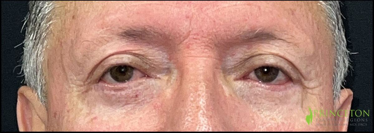 Eyelid Surgery Before and After | Princeton Plastic Surgeons