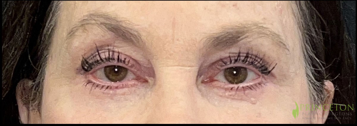 Eyelid Surgery Before and After | Princeton Plastic Surgeons