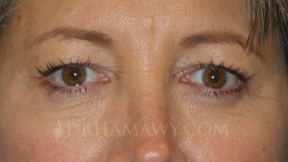 Eyelid Surgery Before and After | Princeton Plastic Surgeons