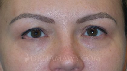 Eyelid Surgery Before and After | Princeton Plastic Surgeons