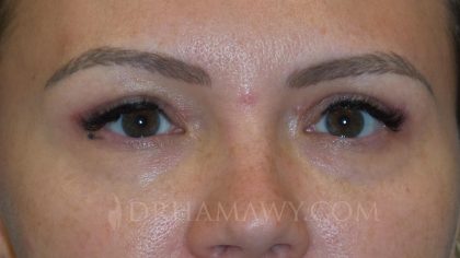 Eyelid Surgery Before and After | Princeton Plastic Surgeons