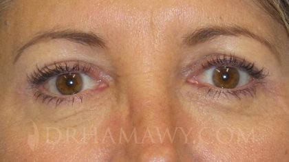 Eyelid Surgery Before and After | Princeton Plastic Surgeons