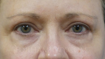 Eyelid Surgery Before and After | Princeton Plastic Surgeons