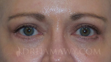 Eyelid Surgery Before and After | Princeton Plastic Surgeons