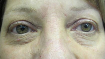 Eyelid Surgery Before and After | Princeton Plastic Surgeons