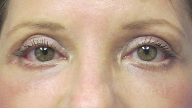 Eyelid Surgery Before and After | Princeton Plastic Surgeons