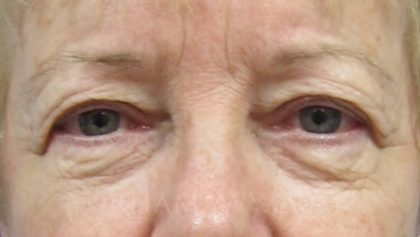 Eyelid Surgery Before and After | Princeton Plastic Surgeons