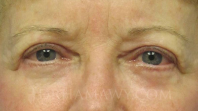 Eyelid Surgery Before and After | Princeton Plastic Surgeons