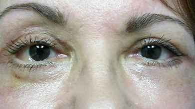 Eyelid Surgery Before and After | Princeton Plastic Surgeons