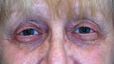 Eyelid Surgery Before and After | Princeton Plastic Surgeons