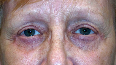 Eyelid Surgery Before and After | Princeton Plastic Surgeons