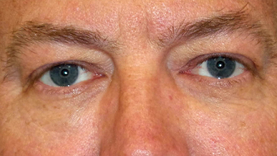 Eyelid Surgery Before and After | Princeton Plastic Surgeons