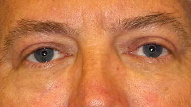 Eyelid Surgery Before and After | Princeton Plastic Surgeons