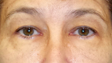 Eyelid Surgery Before and After | Princeton Plastic Surgeons