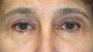 Eyelid Surgery Before and After | Princeton Plastic Surgeons