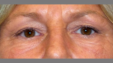 Eyelid Surgery Before and After | Princeton Plastic Surgeons