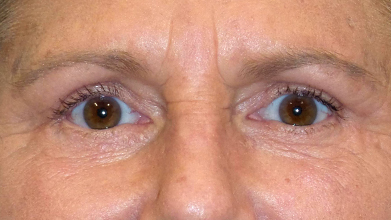 Eyelid Surgery Before and After | Princeton Plastic Surgeons